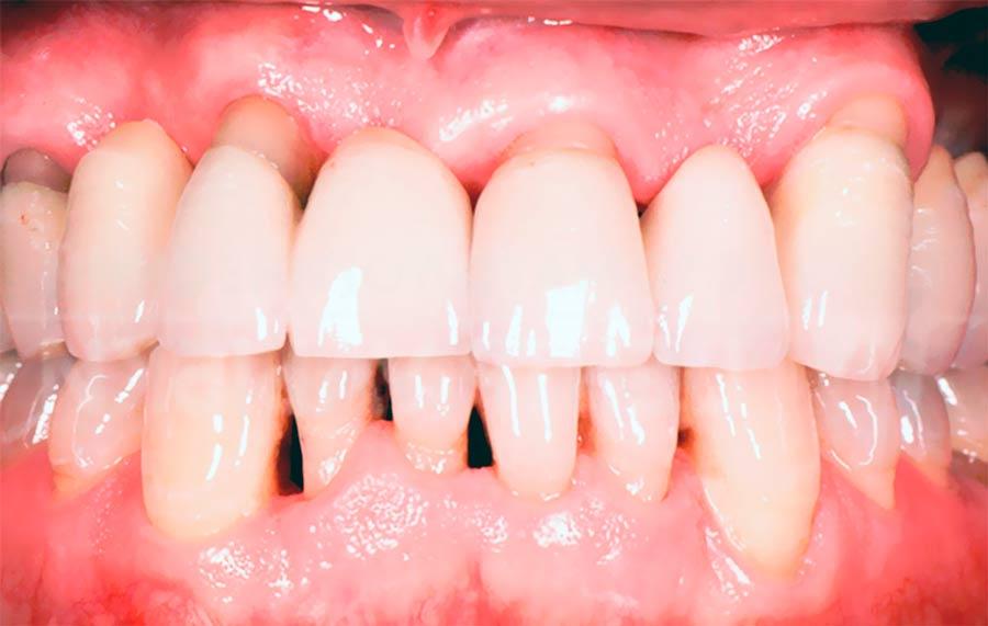 зубы больные пародонтозом