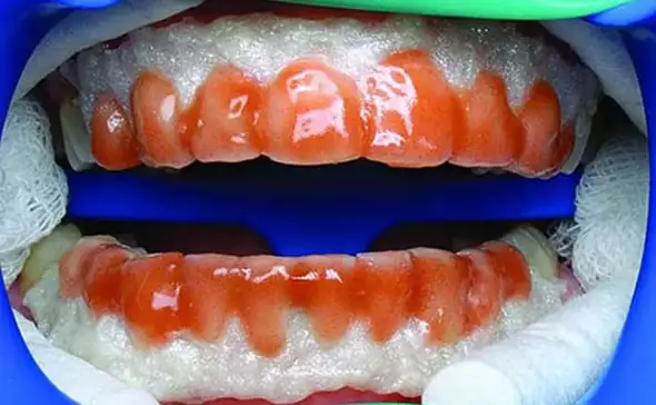 Химическое удаление зубного камня