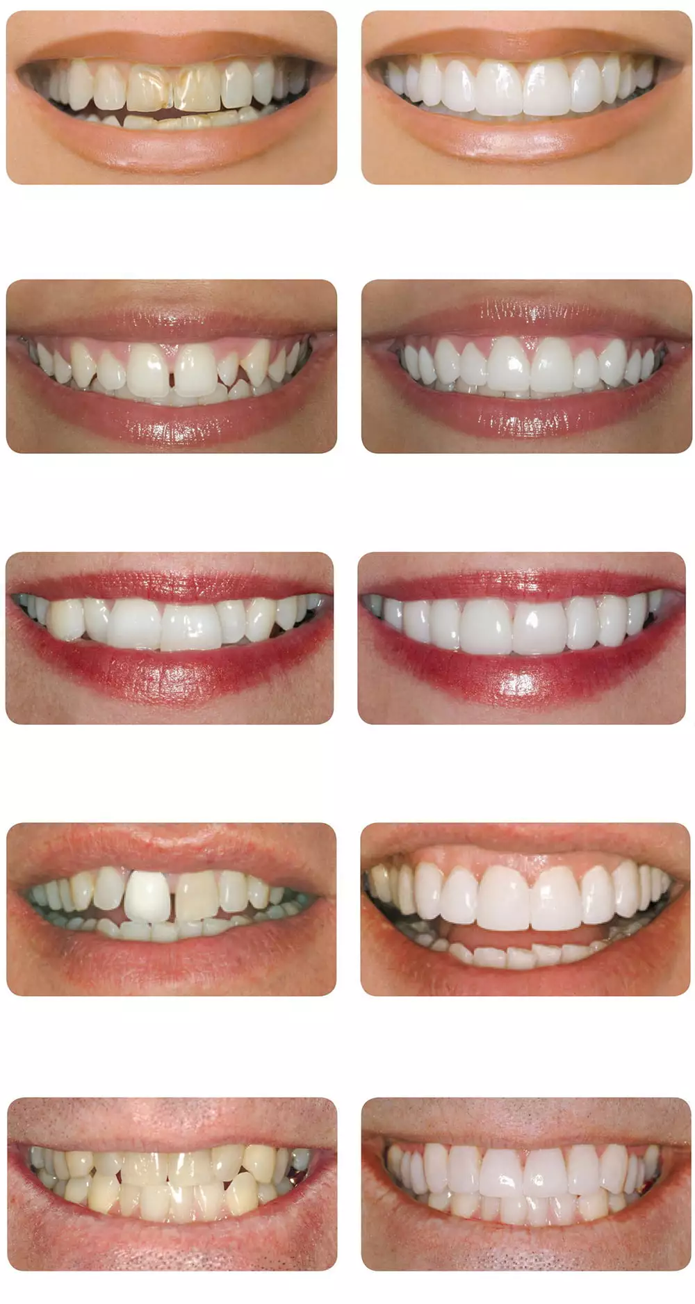 Примеры зубов с люминирами