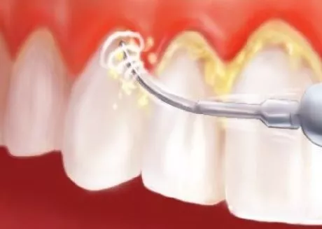 Ультразвуковое удаление зубного камня