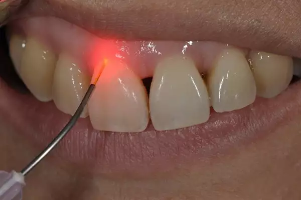 Лазерное удаление зубного камня