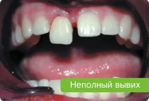 Неполный вывих зуба