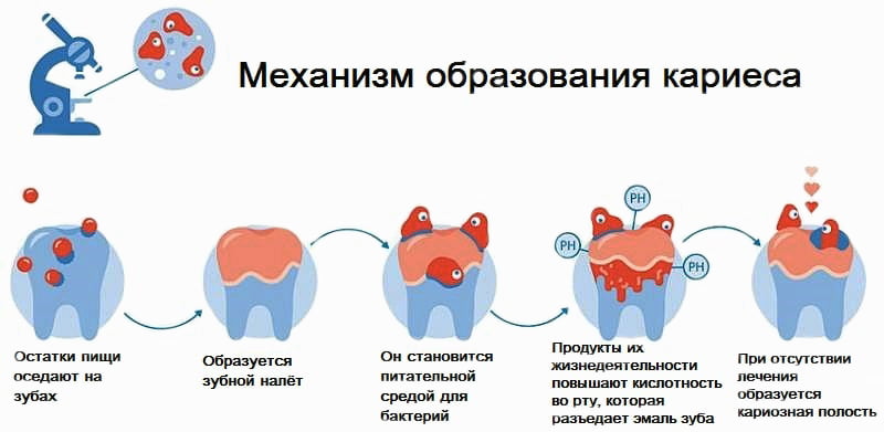 Как убрать зубные камни