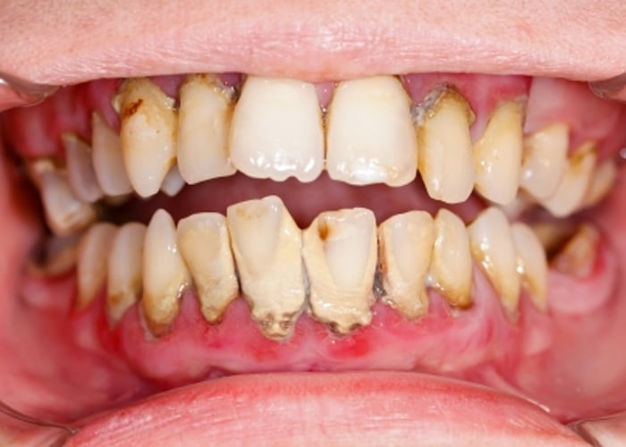 Зубной камень | Как лечить зубной камень