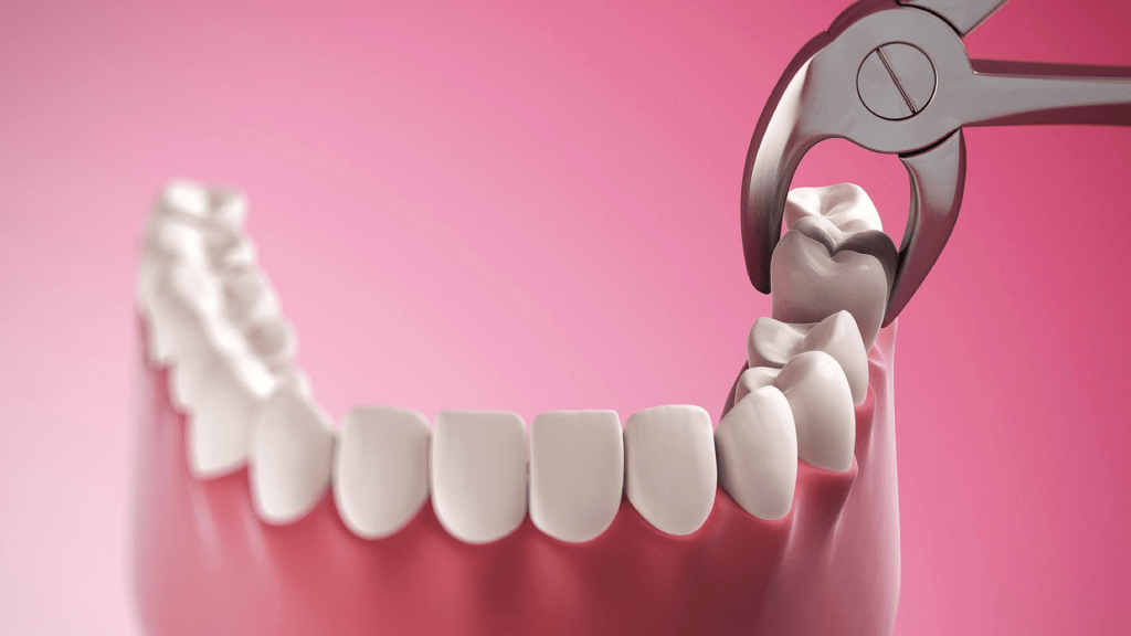 Удаление зуба мудрости