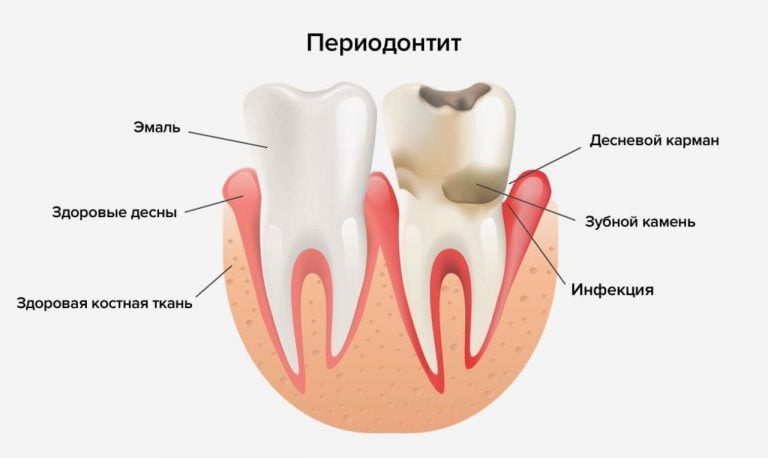 после установки пломбы болит зуб