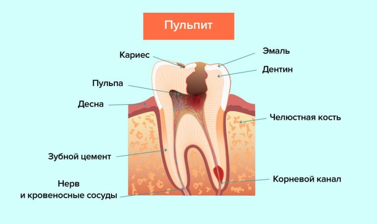 после установки пломбы болит зуб