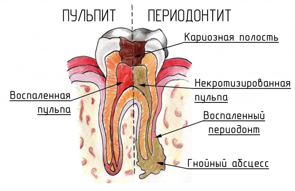 болит зуб под коронкой