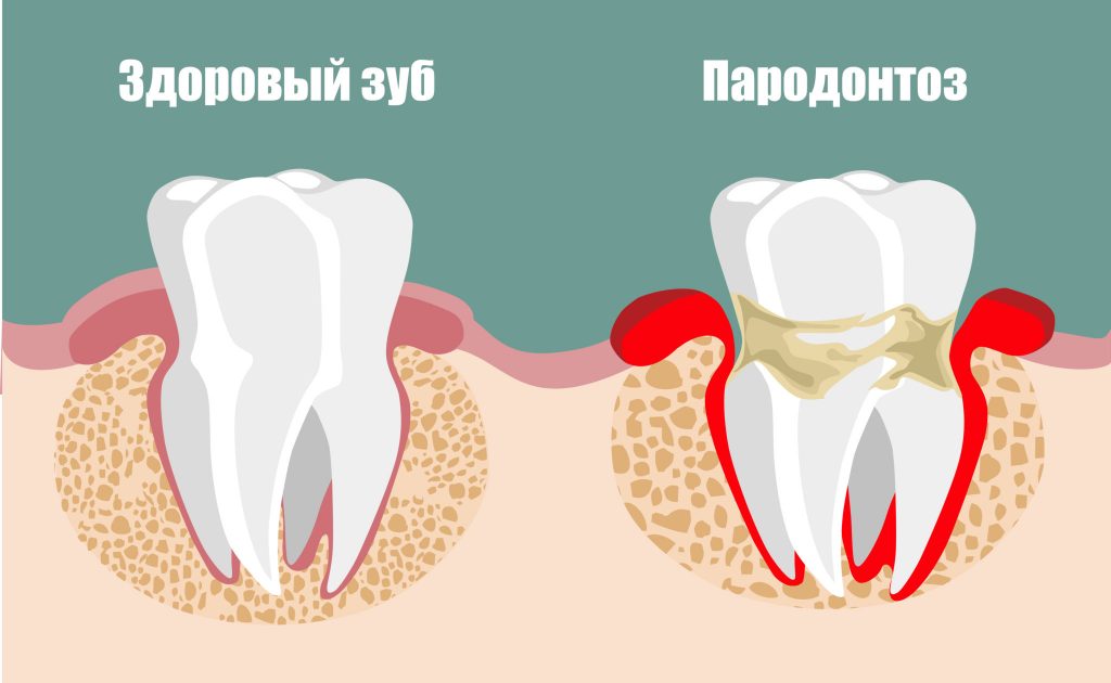 лечение зубов беременным