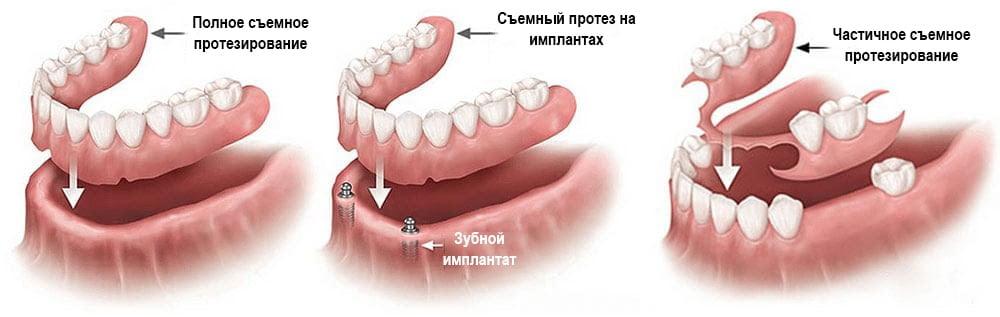 Протезирование и реставрация зубов