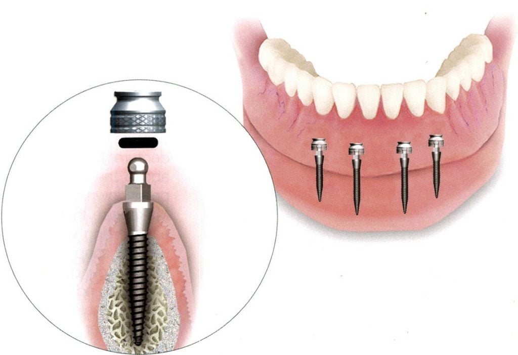 зубные протезы на имплантах
