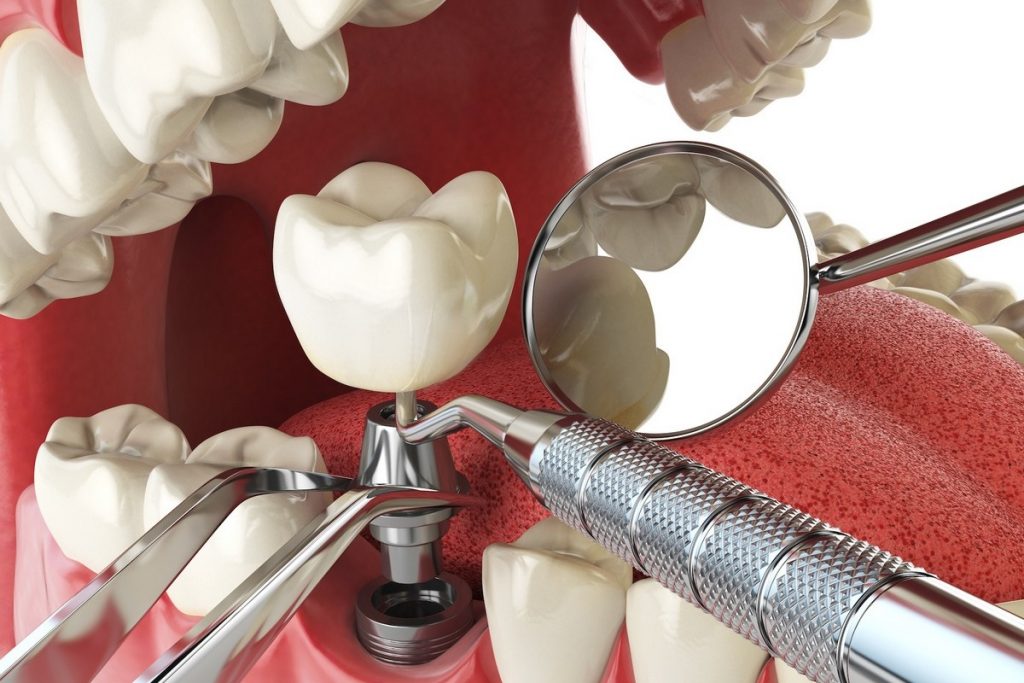 несъемные зубные протезы