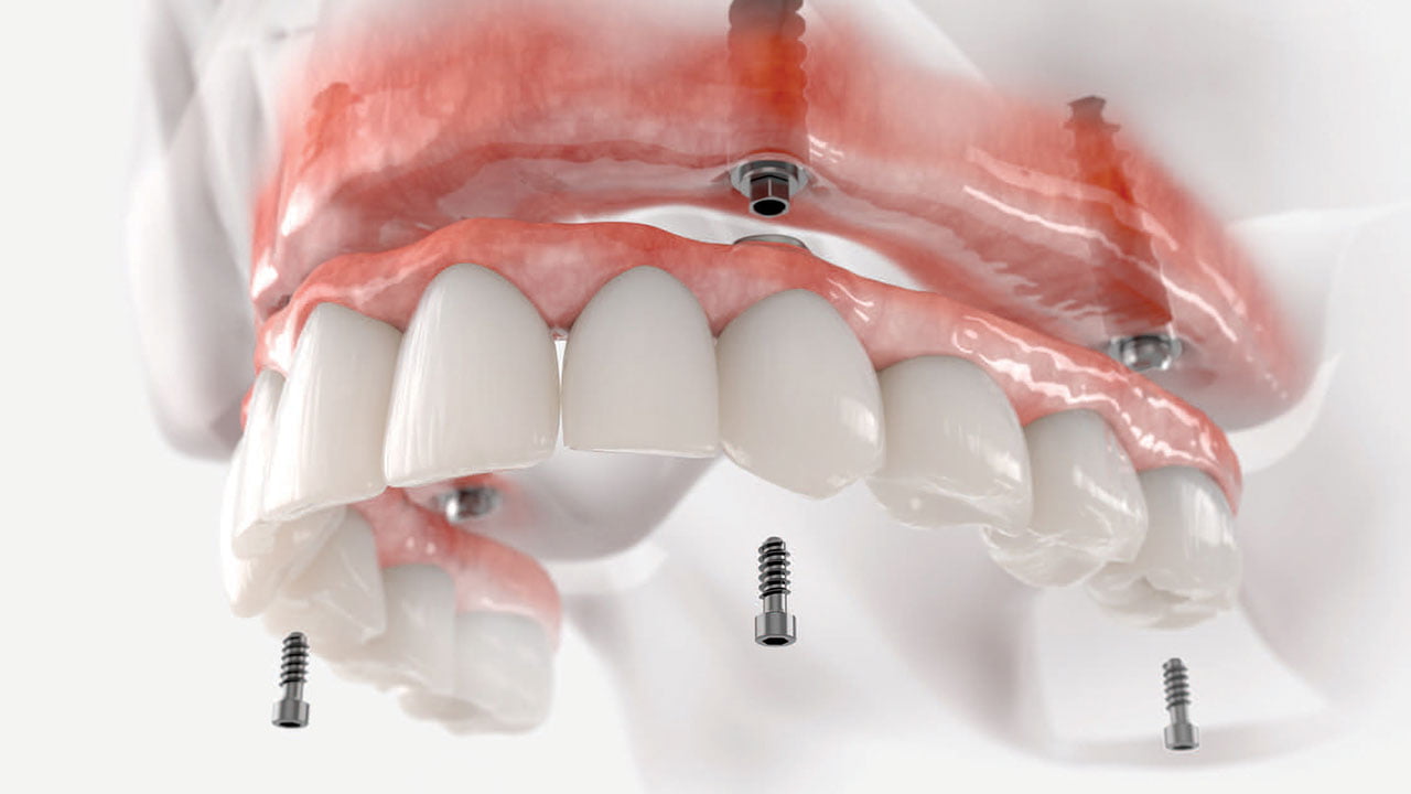 Зубные протезы на имплантах