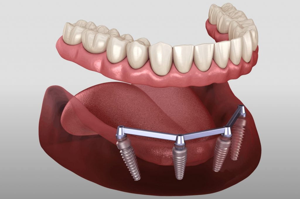 зубные протезы на имплантах