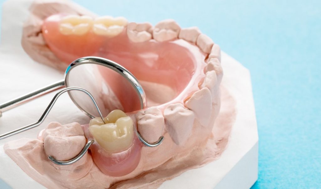 Частичные съемные зубные протезы