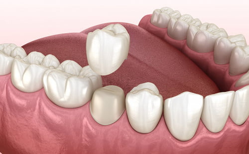 Коронка как несъемный зубной протез