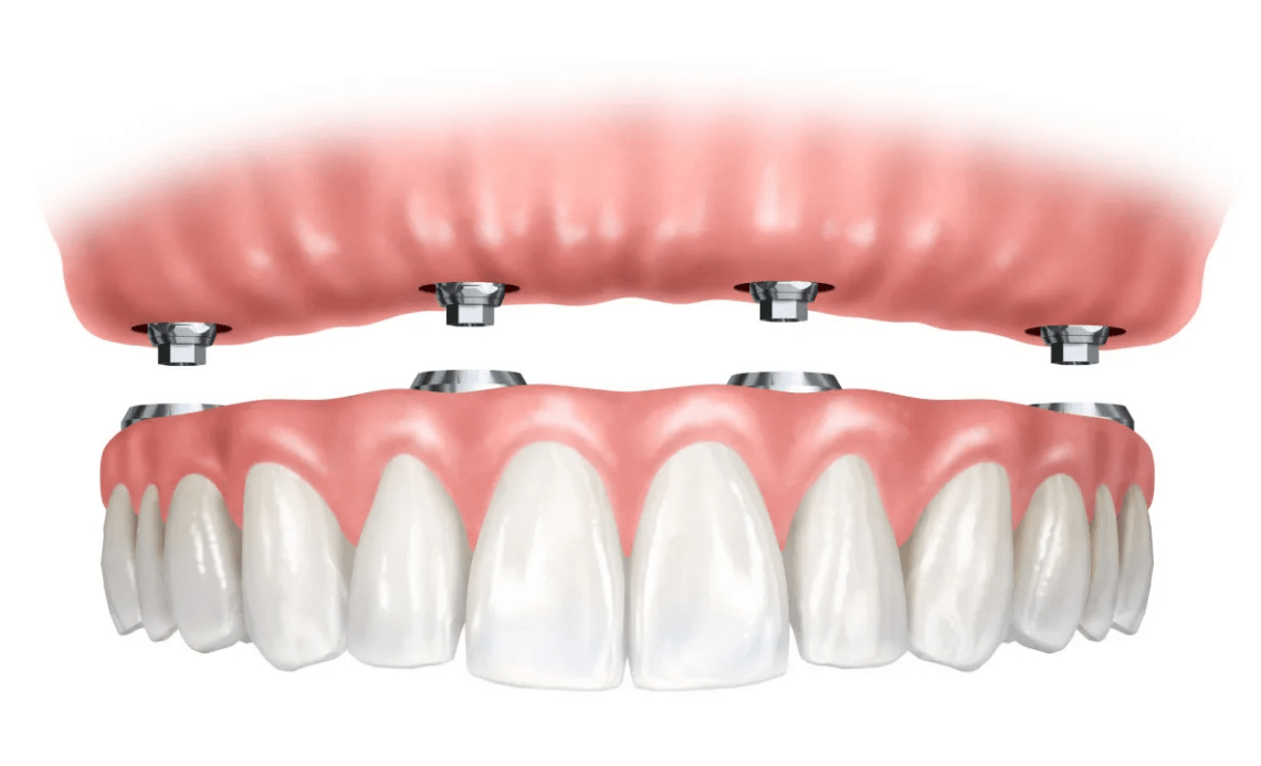 Полное зубное протезирование на имплантах