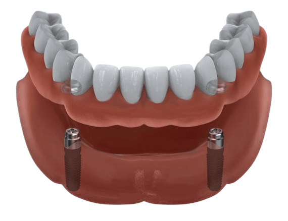 Полное зубное протезирование на имплантах