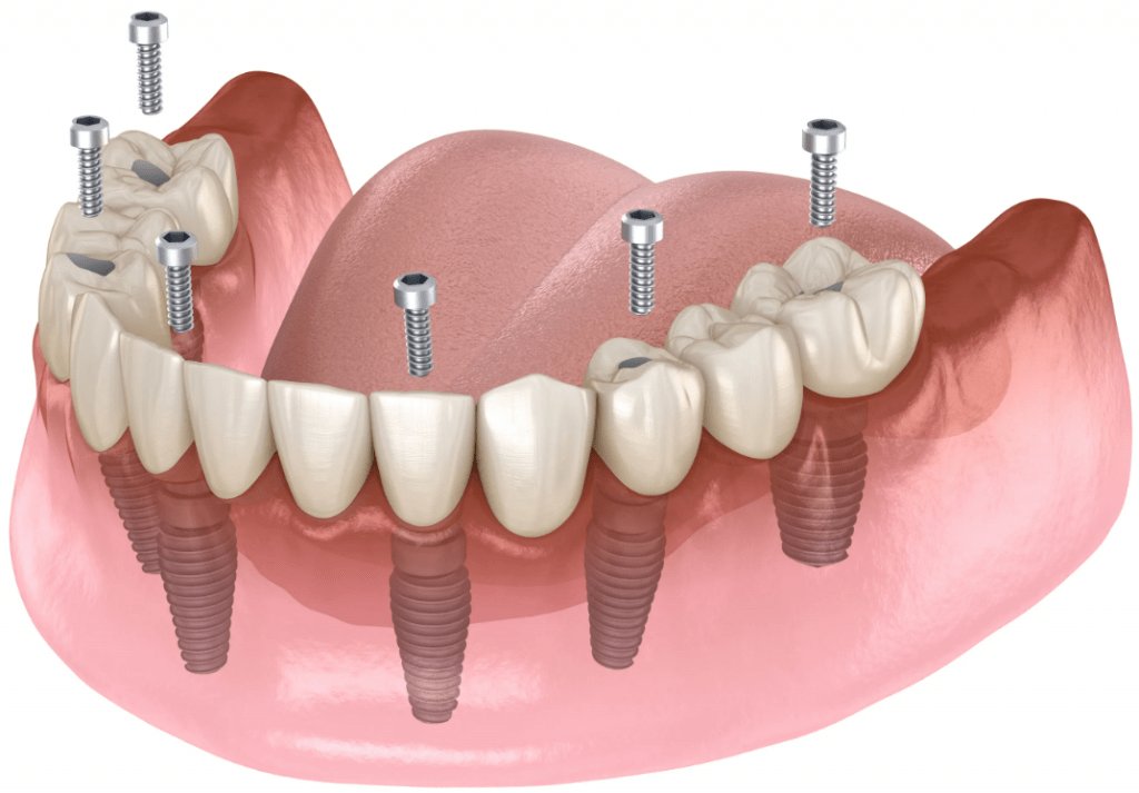 Полное зубное протезирование на имплантах