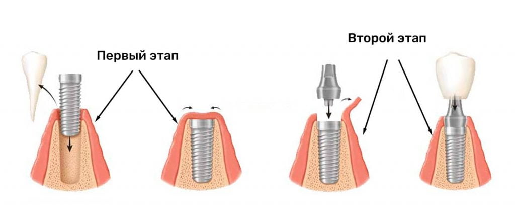 классическая двухэтапная имплантация