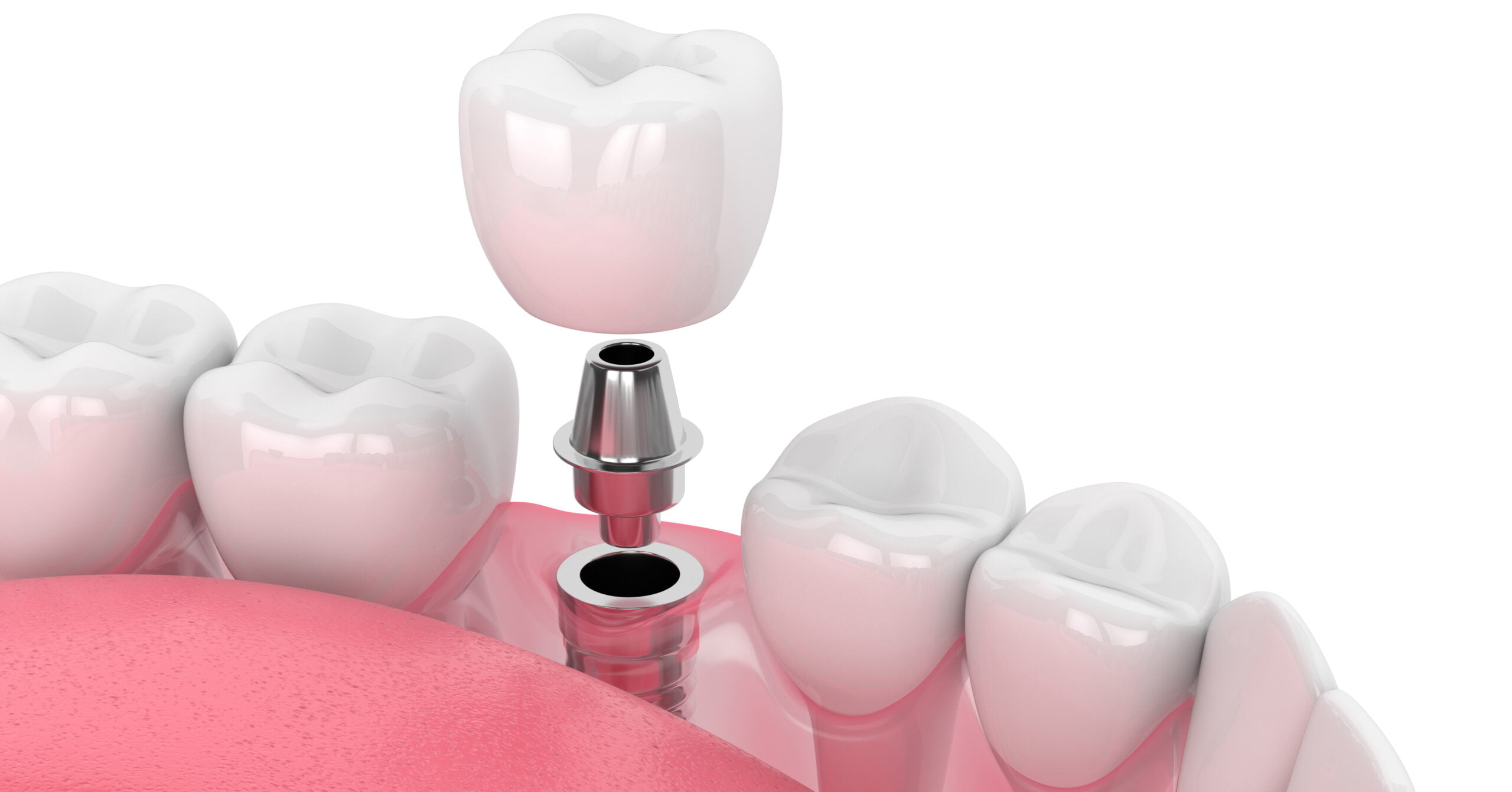 Классическая двухэтапная имплантация зубов