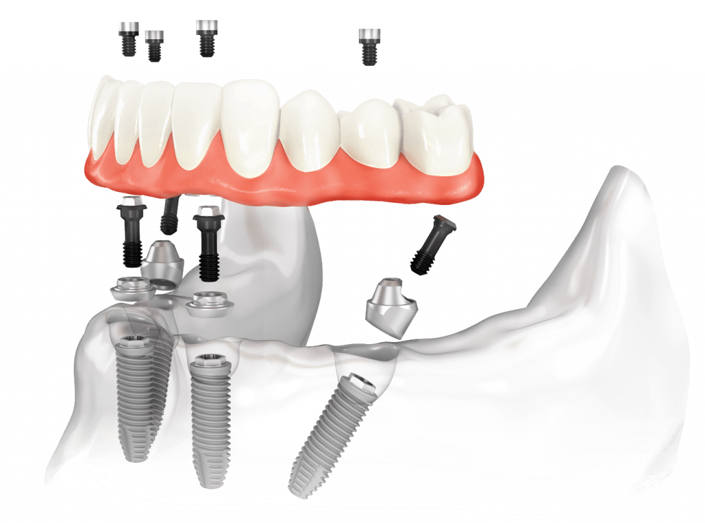 Имплантация зубов All-on-4