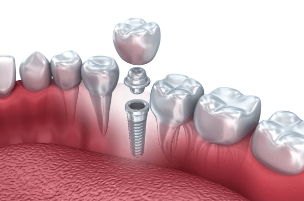 имплантат на месте удаленного зуба