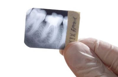 Прицельный снимок зуба, пример