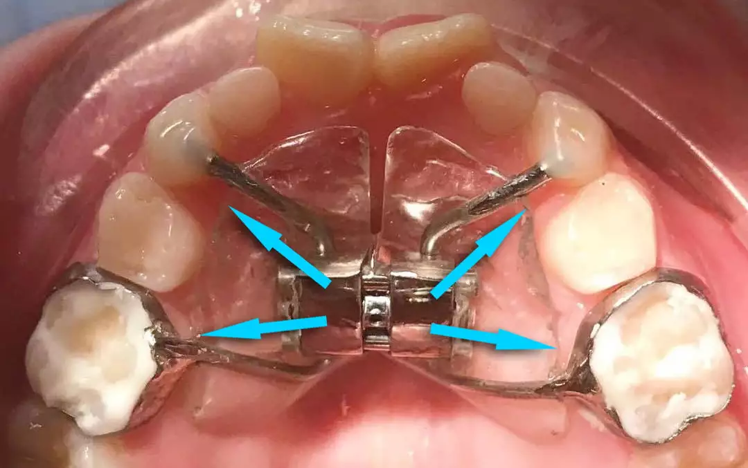 Действие пластины Марко Росса