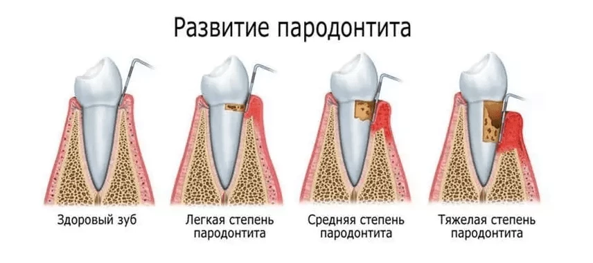 Развитие пародонтита