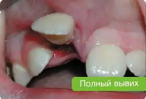 Полный вывих зуба