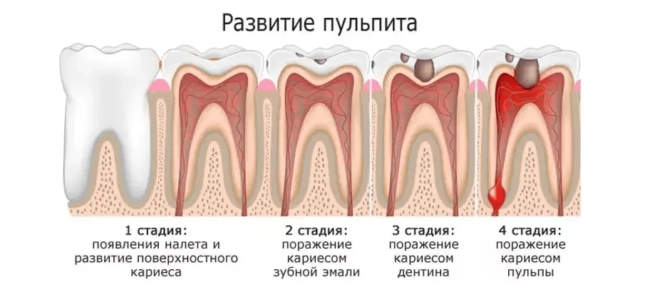 Развитие пульпита