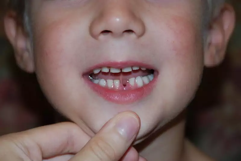 Ребенок выбил зуб