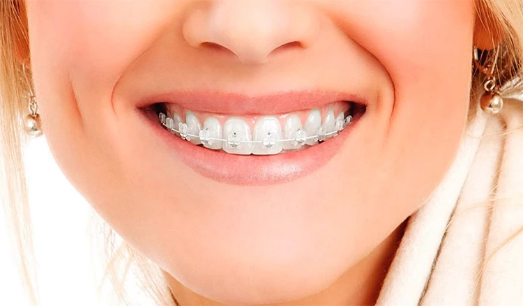 Как ухаживать за брекетами