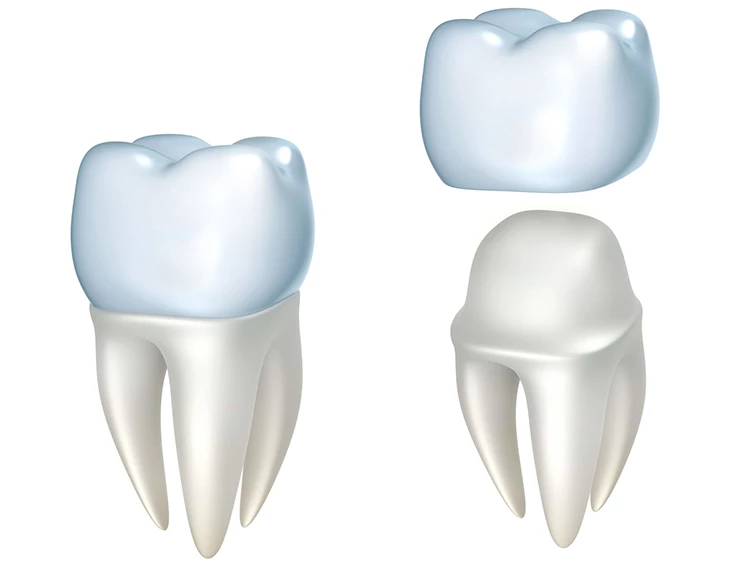 Зубные коронки: пример лечения до и после