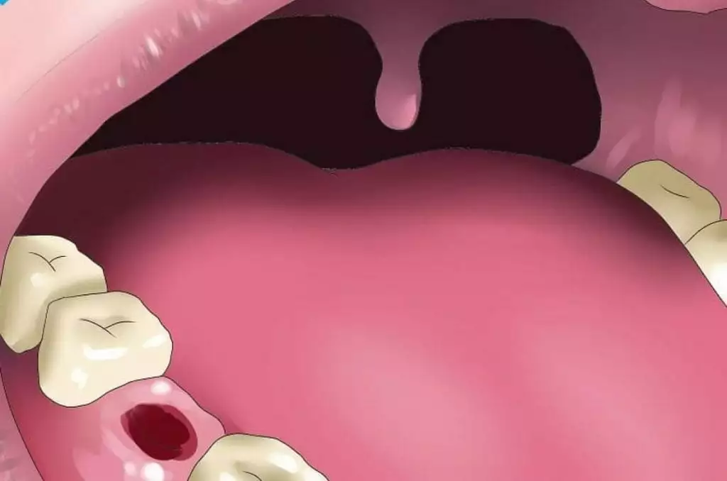 температура после удаления зуба мудрости