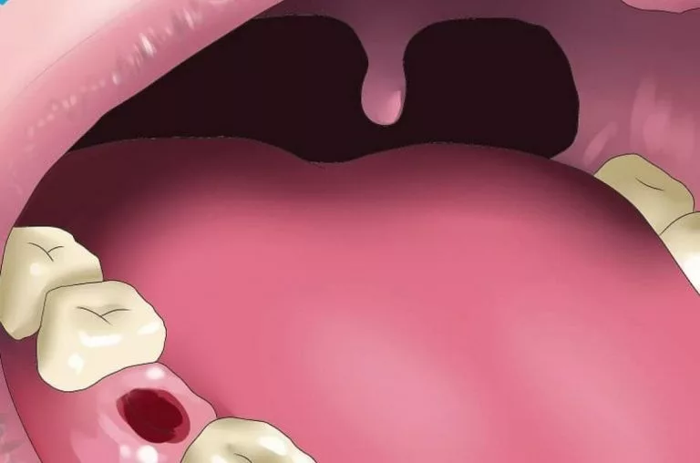 после установки пломбы болит зуб