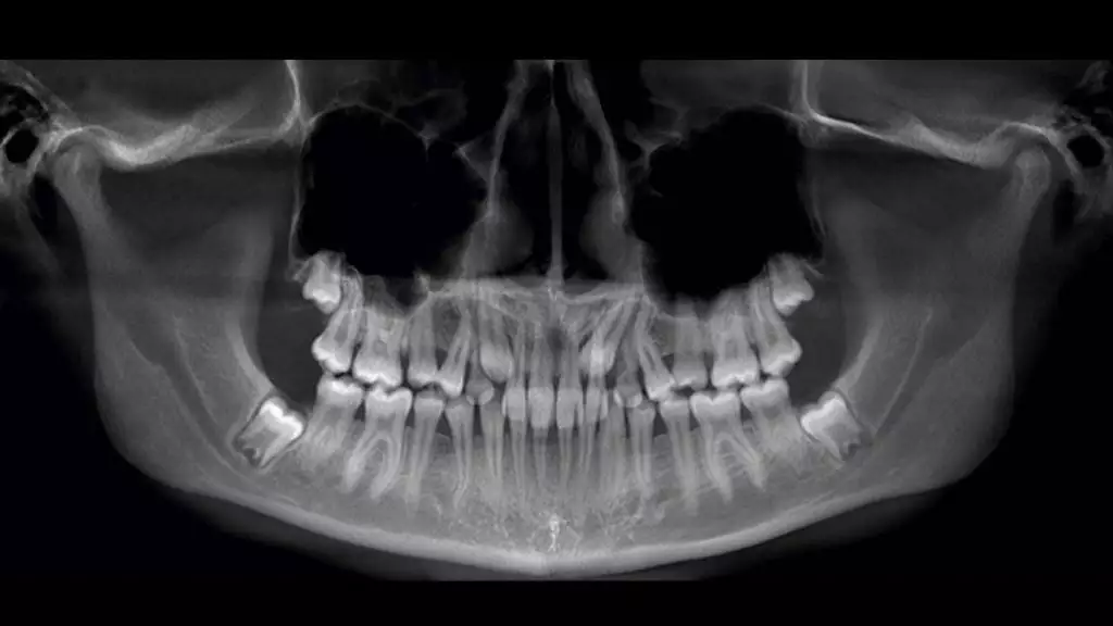 сколько каналов в зубах