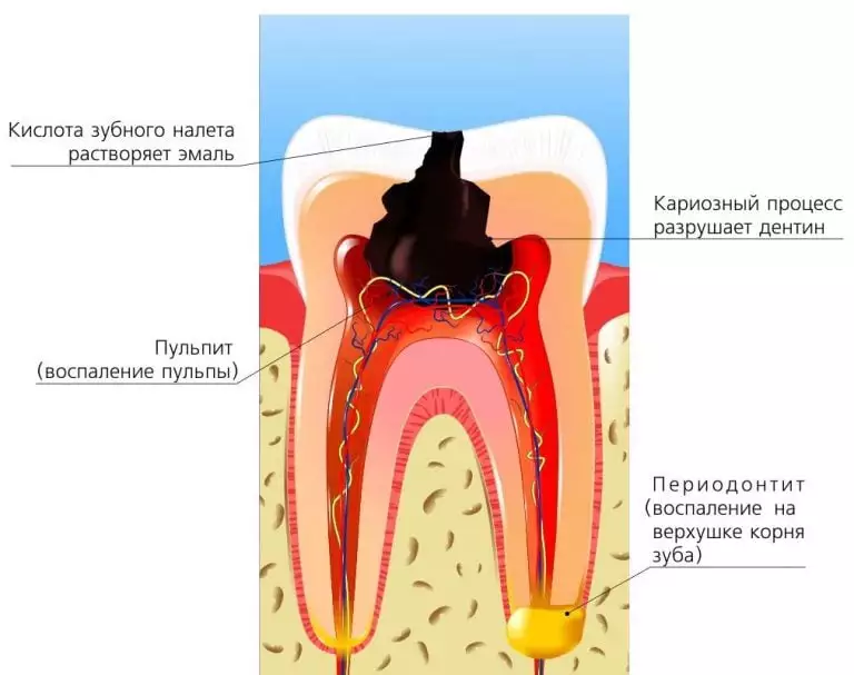 лечение корня зуба