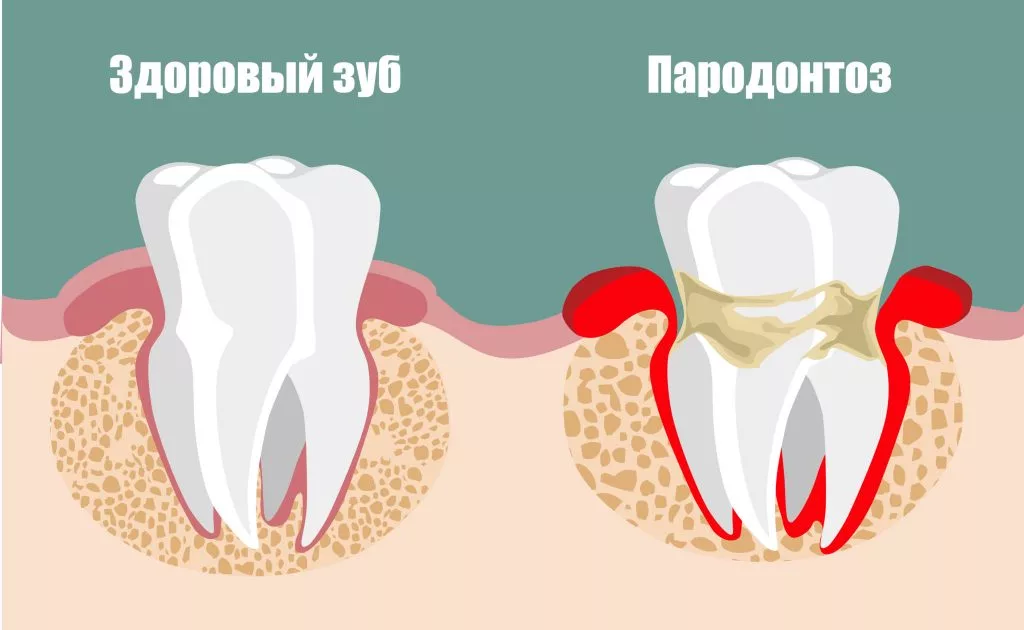 лечение зубов беременным