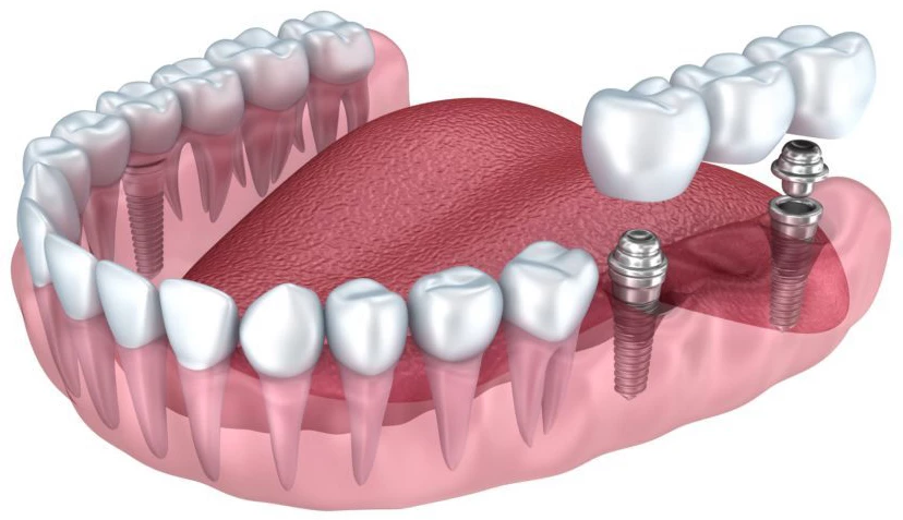 протезирование зубов