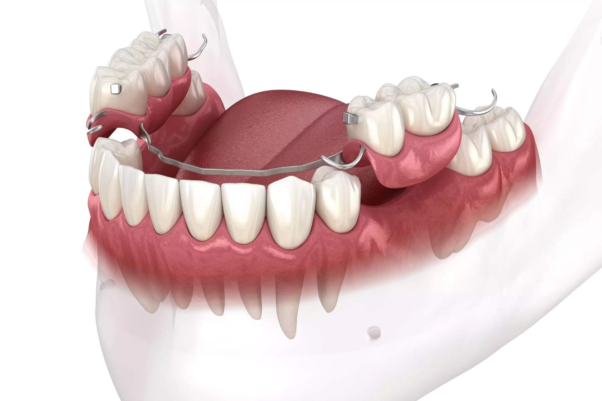 Частичные съемные зубные протезы