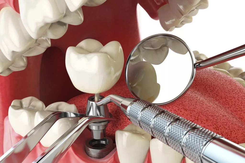 несъемные зубные протезы