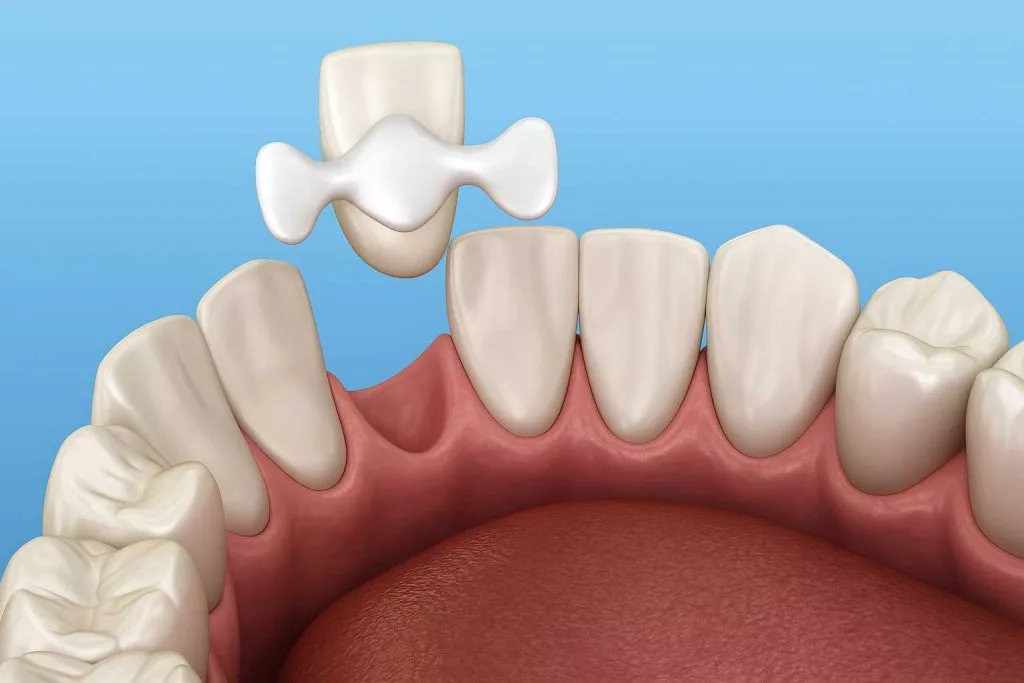 Мост как несъемный зубной протез