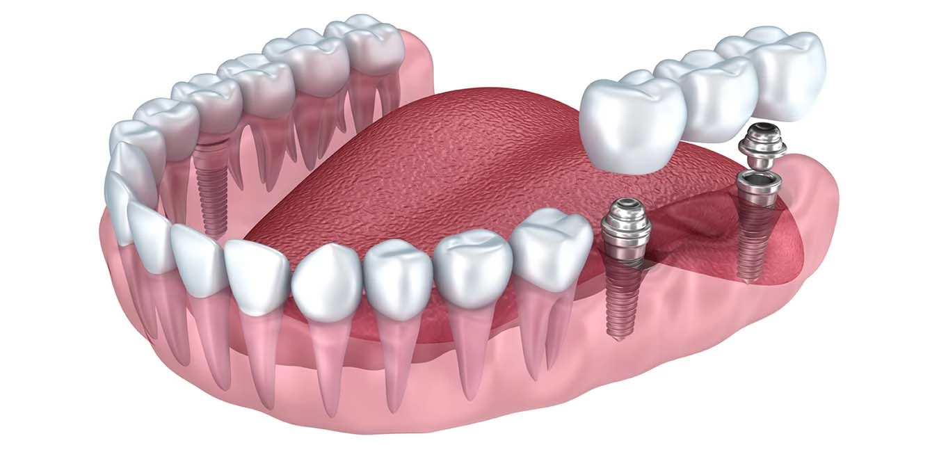 условно-съемные зубные протезы