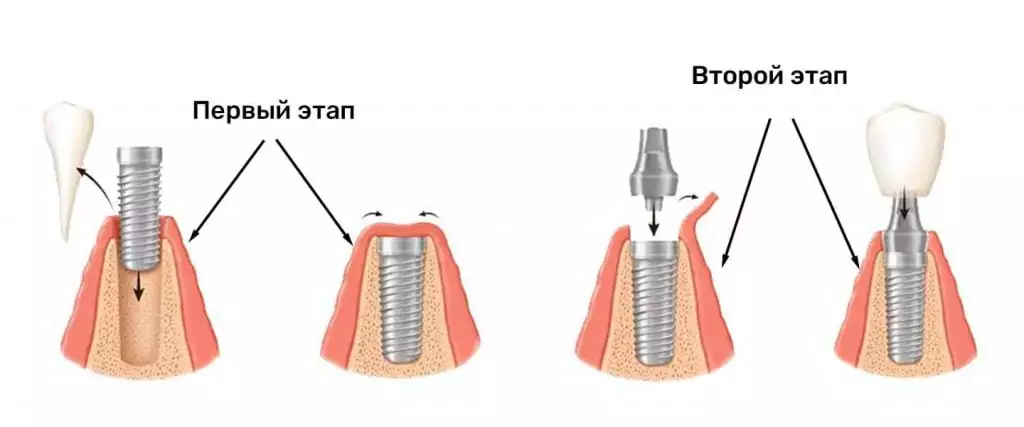 классическая двухэтапная имплантация
