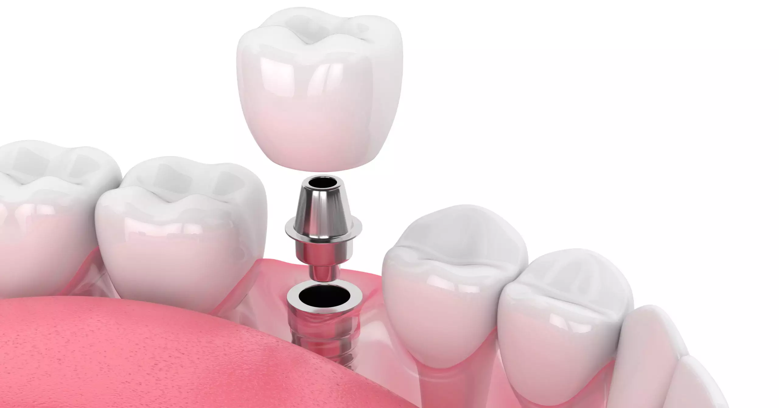 Классическая двухэтапная имплантация зубов